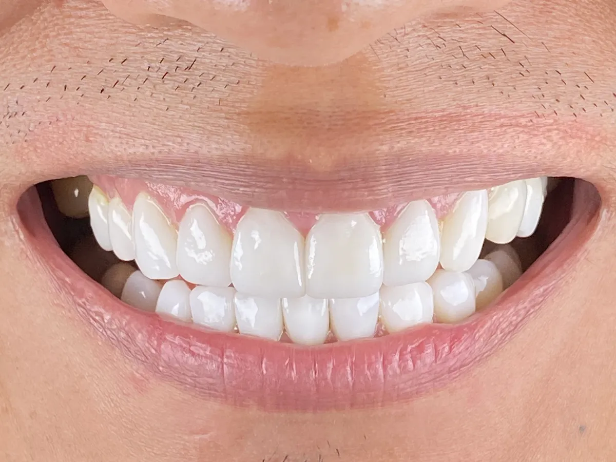 Después: sonrisa blanca y pareja