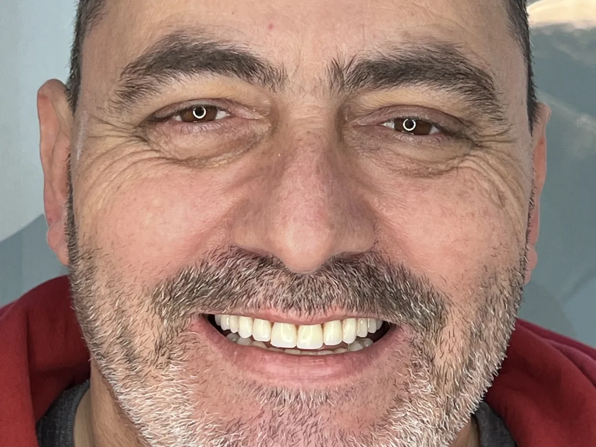 Después: sonrisa completa con implantes